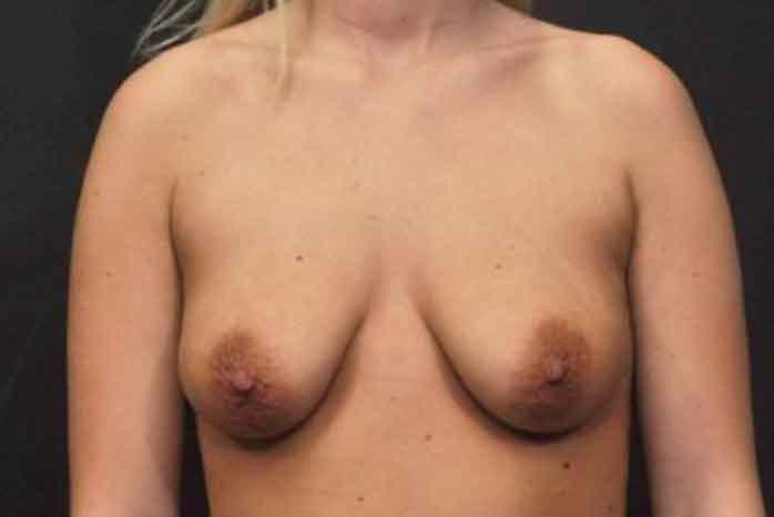 Case #1370 – Breast Lift
