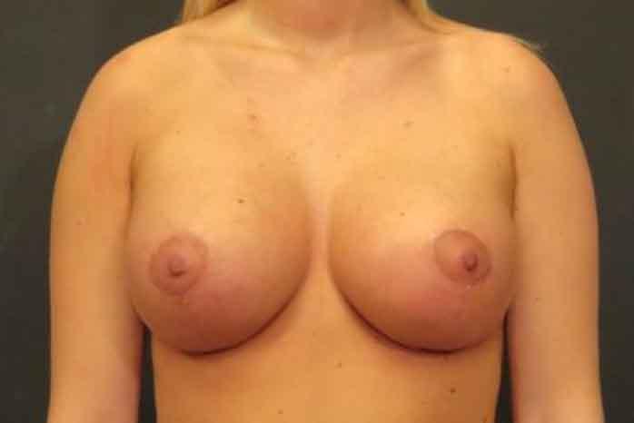Case #1370 – Breast Lift