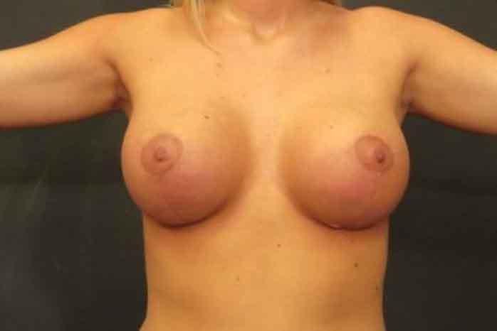 Case #1370 – Breast Lift
