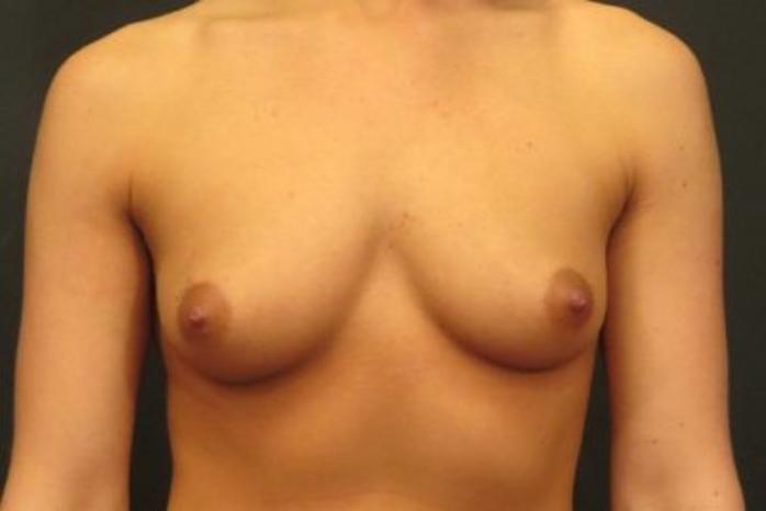 Case #1382 – Breast Augmentation