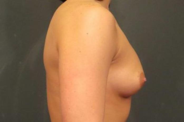Case #1382 – Breast Augmentation