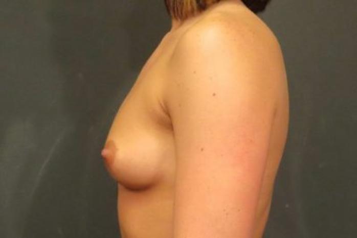 Case #1382 – Breast Augmentation