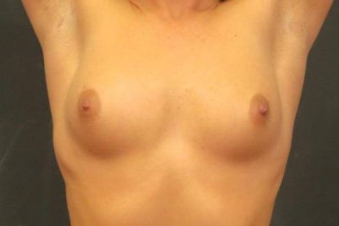 Case #1382 – Breast Augmentation