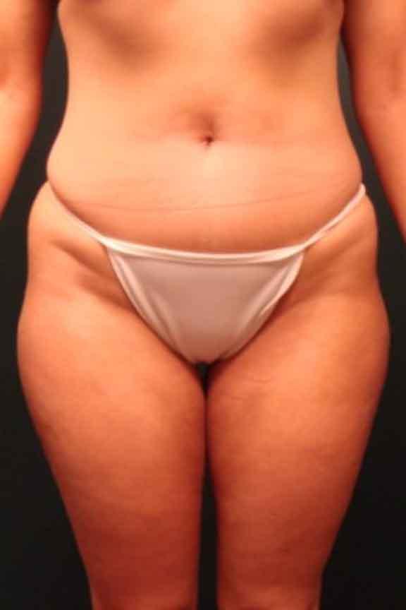 Case #138 – Brazilian Butt Lift