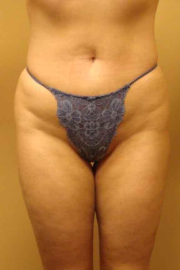 Case #138 – Brazilian Butt Lift