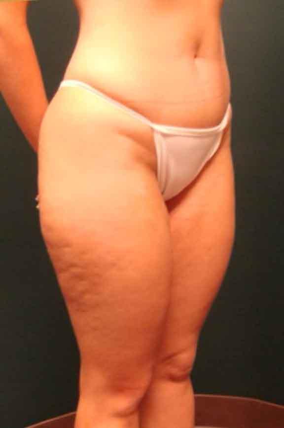 Case #138 – Brazilian Butt Lift