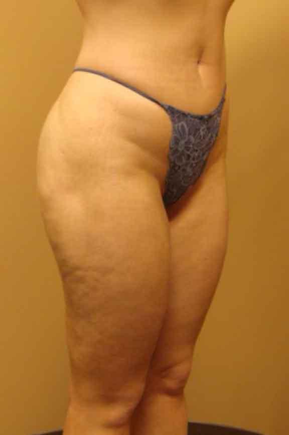 Case #138 – Brazilian Butt Lift