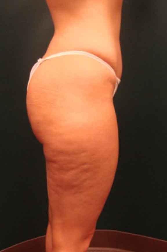 Case #138 – Brazilian Butt Lift