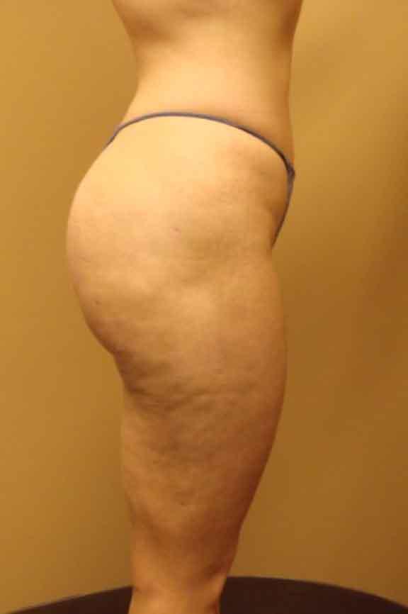 Case #138 – Brazilian Butt Lift