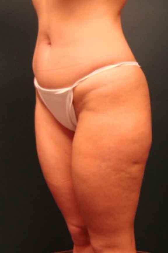 Case #138 – Brazilian Butt Lift