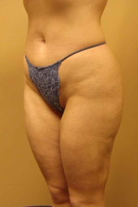 Case #138 – Brazilian Butt Lift