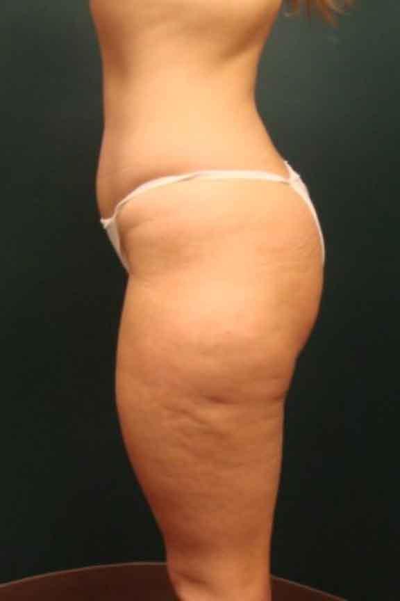 Case #138 – Brazilian Butt Lift