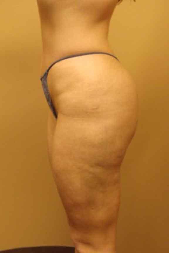 Case #138 – Brazilian Butt Lift