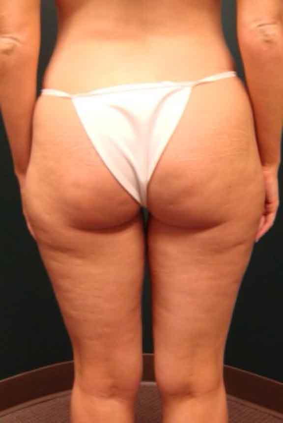 Case #138 – Brazilian Butt Lift
