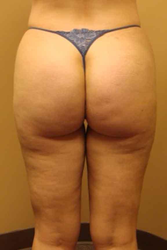 Case #138 – Brazilian Butt Lift