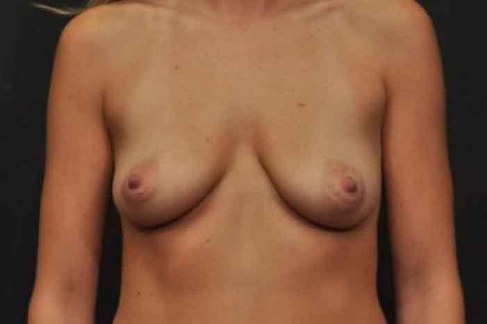 Case #1432 – Breast Augmentation