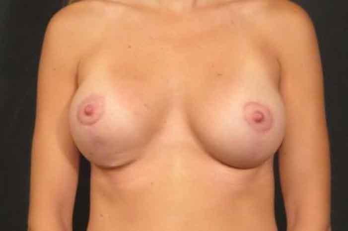 Case #1432 – Breast Augmentation