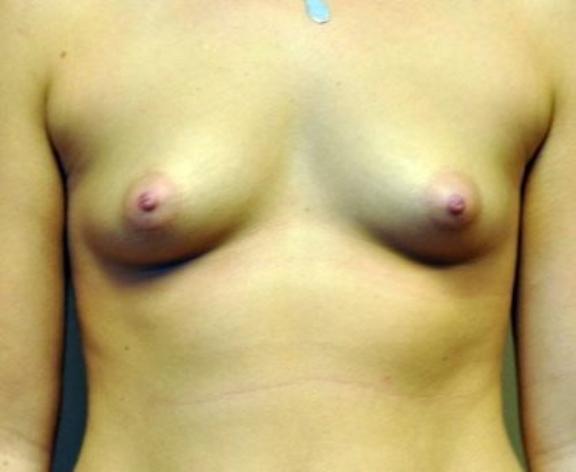 Case #1601 – Breast Augmentation