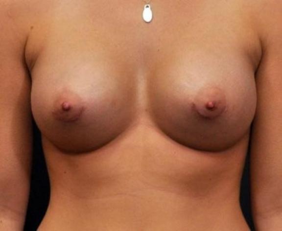 Case #1601 – Breast Augmentation