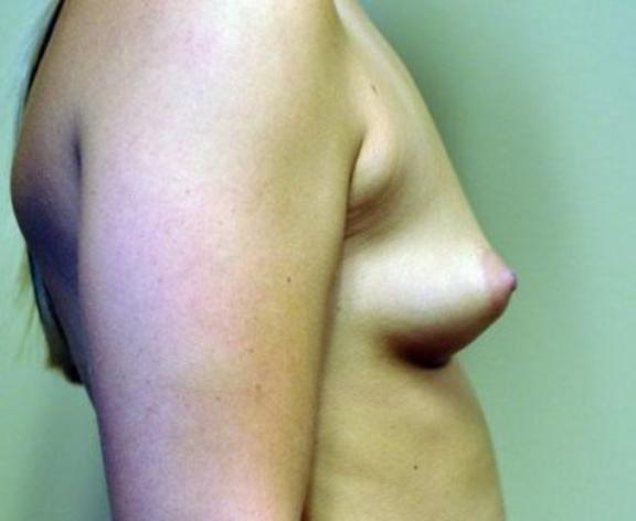 Case #1601 – Breast Augmentation