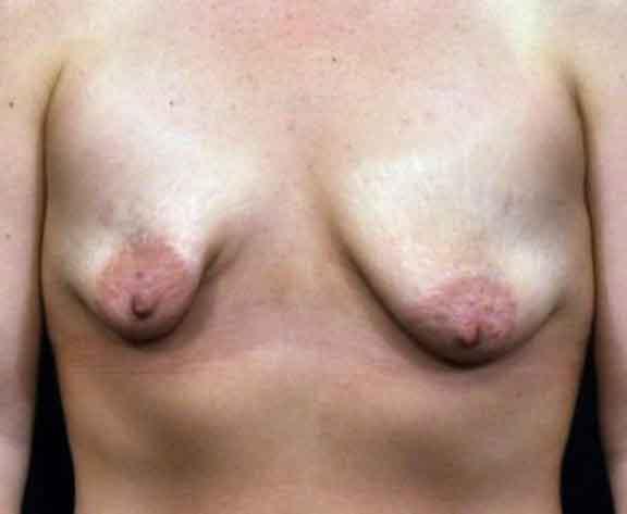 Case #1617 – Breast Augmentation