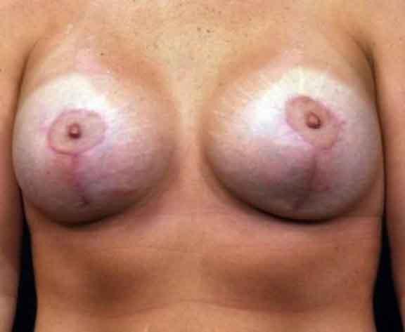 Case #1617 – Breast Augmentation