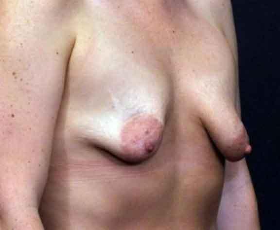Case #1617 – Breast Augmentation