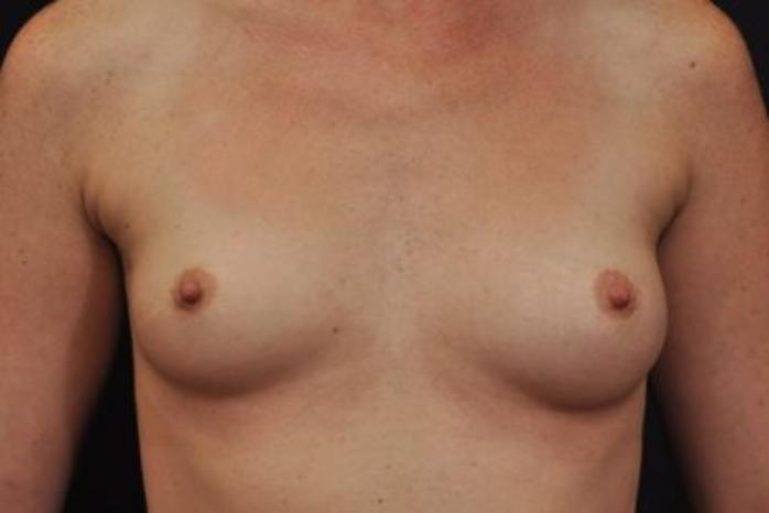 Case #1628 – Breast Augmentation