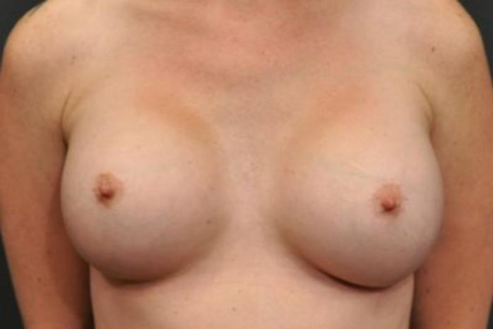 Case #1628 – Breast Augmentation
