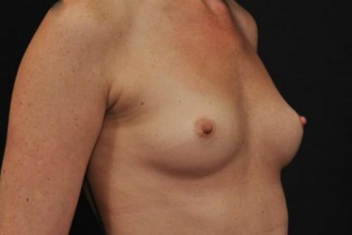 Case #1628 – Breast Augmentation