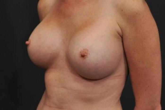 Case #1628 – Breast Augmentation