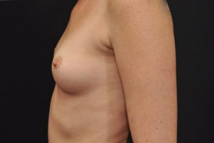 Case #1628 – Breast Augmentation