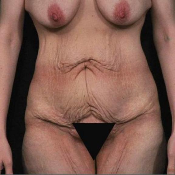Case #162 – SmartLipo