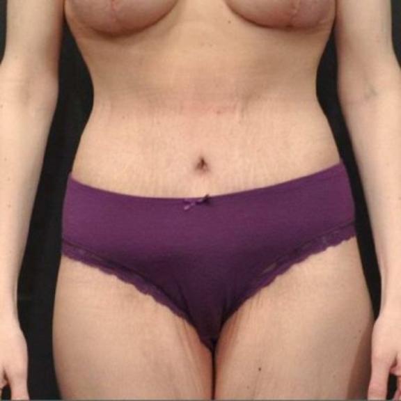 Case #162 – SmartLipo