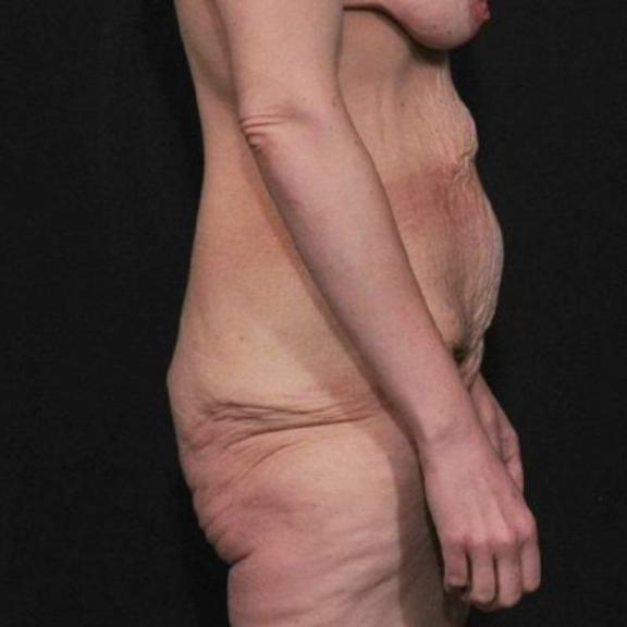 Case #162 – SmartLipo