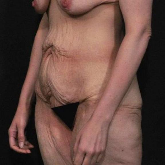Case #162 – SmartLipo
