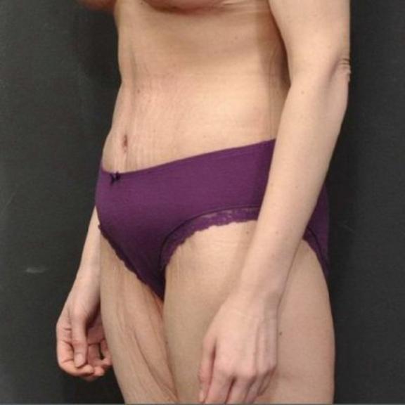 Case #162 – SmartLipo