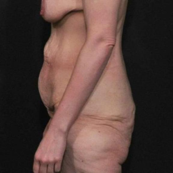 Case #162 – SmartLipo