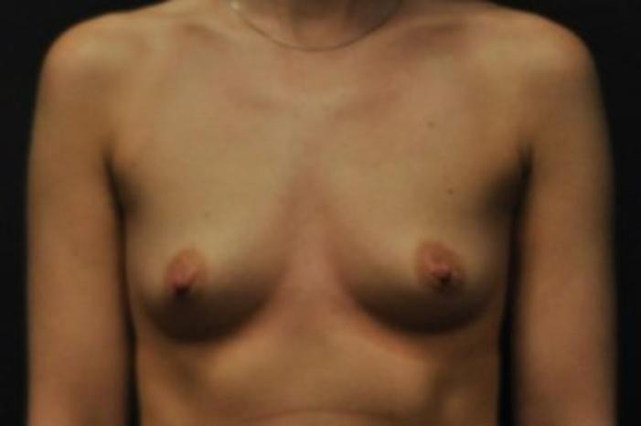 Case #1643 – Breast Augmentation