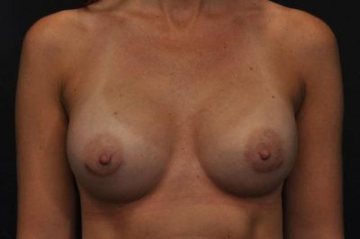 Case #1643 – Breast Augmentation