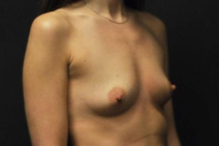 Case #1643 – Breast Augmentation