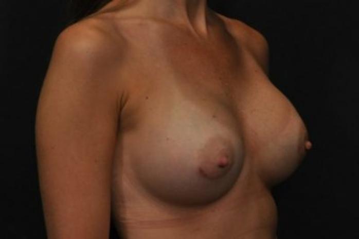 Case #1643 – Breast Augmentation