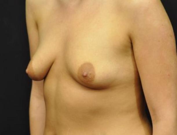 Case #1655 – Breast Augmentation