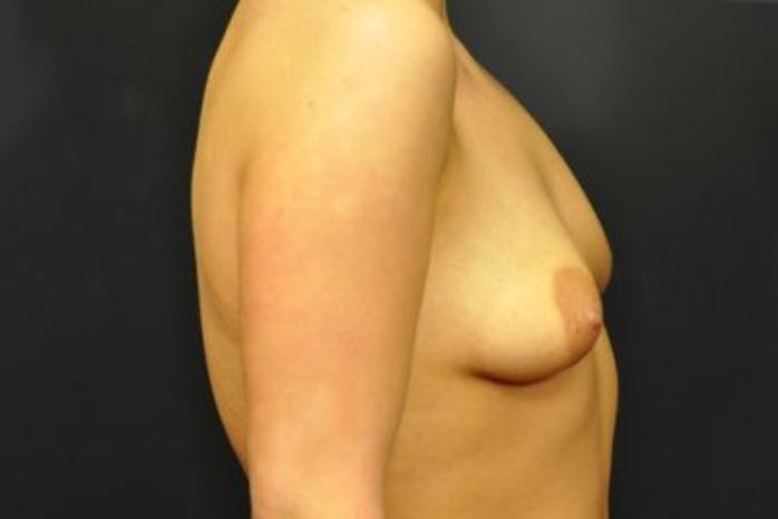 Case #1655 – Breast Augmentation