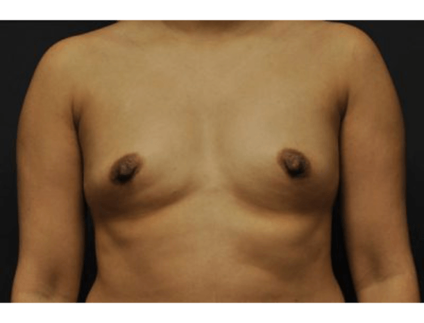 Case #1671 – Breast Augmentation
