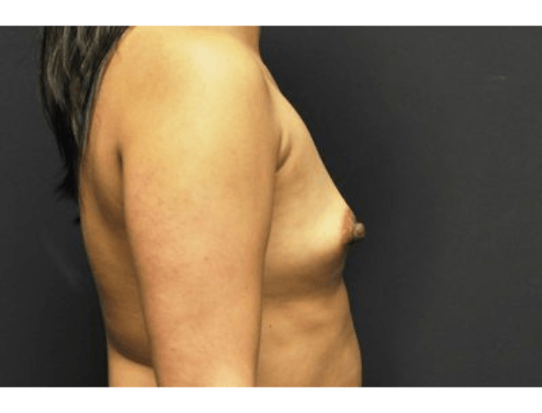 Case #1671 – Breast Augmentation