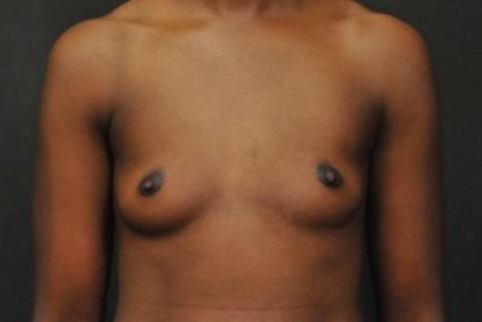 Case #1683 – Breast Augmentation