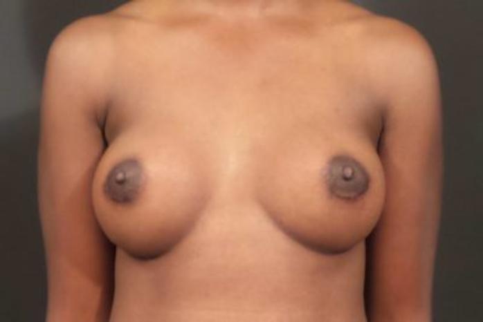 Case #1683 – Breast Augmentation