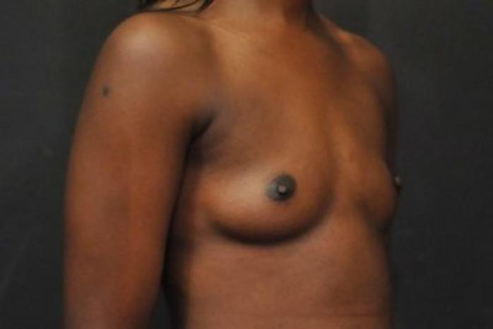 Case #1683 – Breast Augmentation