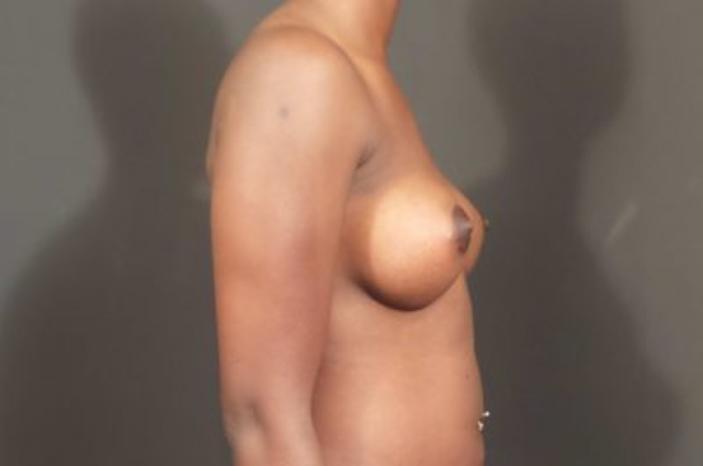 Case #1683 – Breast Augmentation
